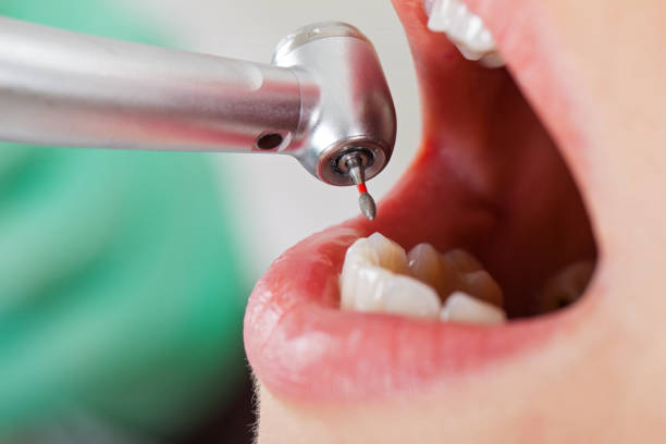 Best Emergency Dentist for Lost Fillings or Crowns in Rancho Viejo, TX